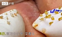 挤黑头痘痘视频,告别肌肤困扰