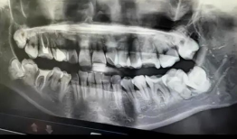 拔智齿视频,视频带你直观体验