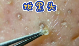 挤黑头痘痘视频,告别肌肤困扰