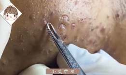 挤黑头痘痘视频,告别肌肤困扰